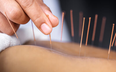 What is Acupuncture? | A Beginners Guide